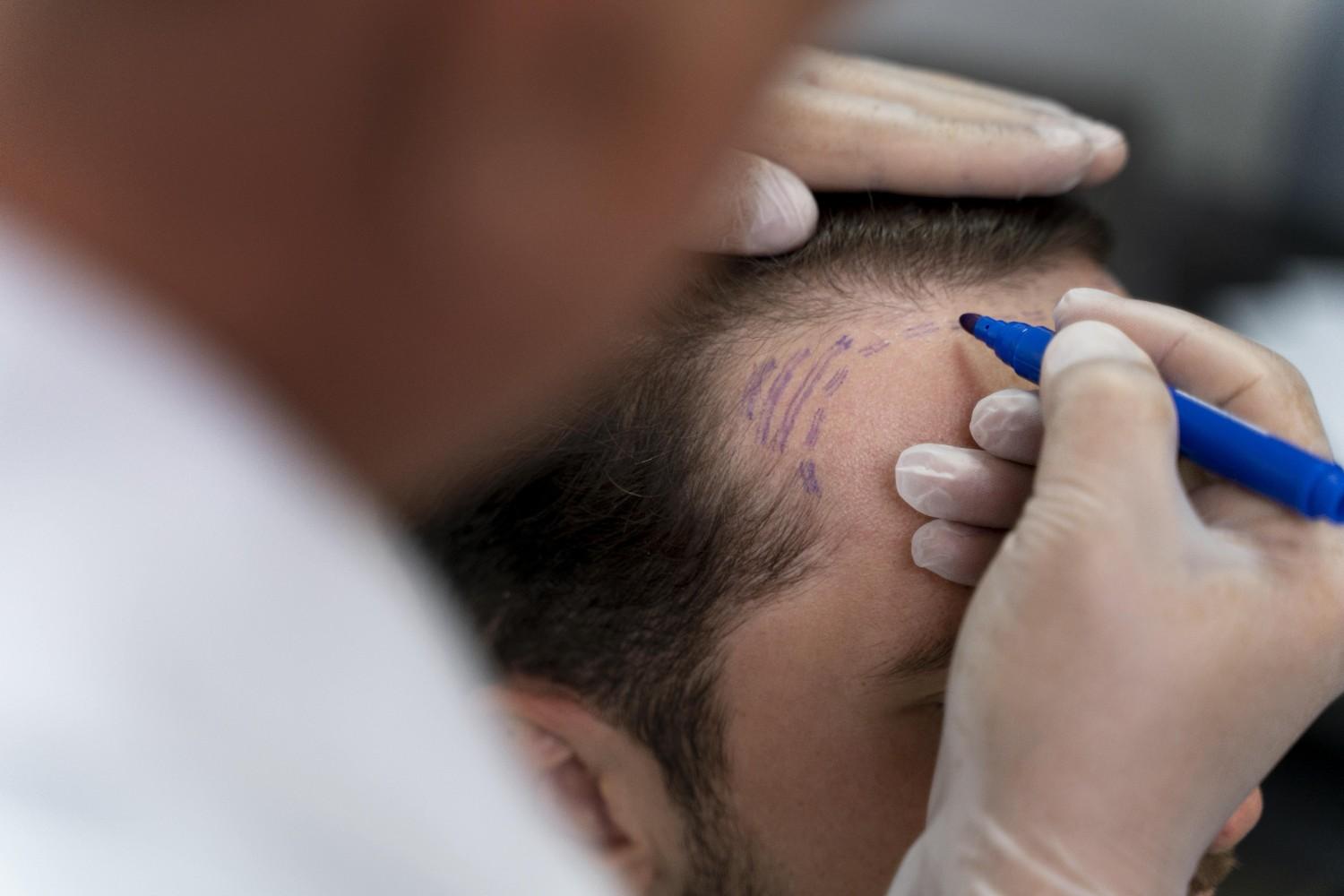 Hair Patches Info